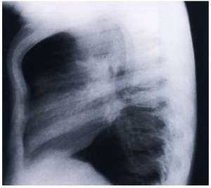 تصویر 3. رادیوگرافی نیمرخ بیمار PC