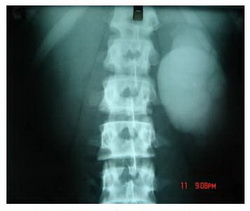 تصویر 2: IVP در بیمار مبتلا به UPJO طرف چپ