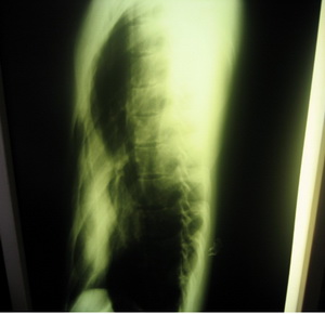 تصویر 5. رادیوگرافی نیم‌رخ بیماری با پکتوس اکس‌کاواتوم که فاصله‌ی استرنوم تا ستون فقرات خیلی کم است