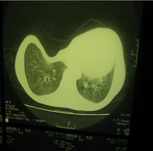  تصویر 6. سی‌تی اسکن بیماری با پکتوس اکس‌کاواتوم که ریه‌ی چپ تحت فشار است